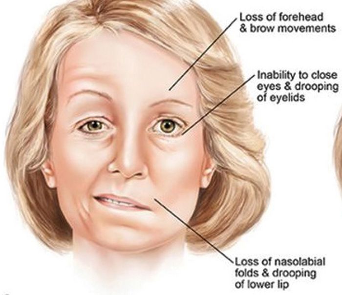 17 Bells Palsy ideas  bells palsy, types of facials, paralysis